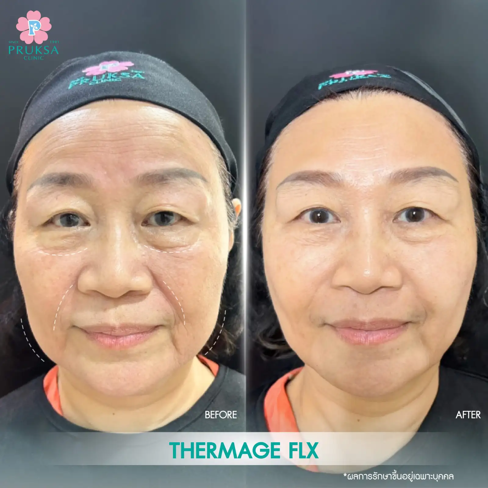 BFAT-THERMAGE-FLX