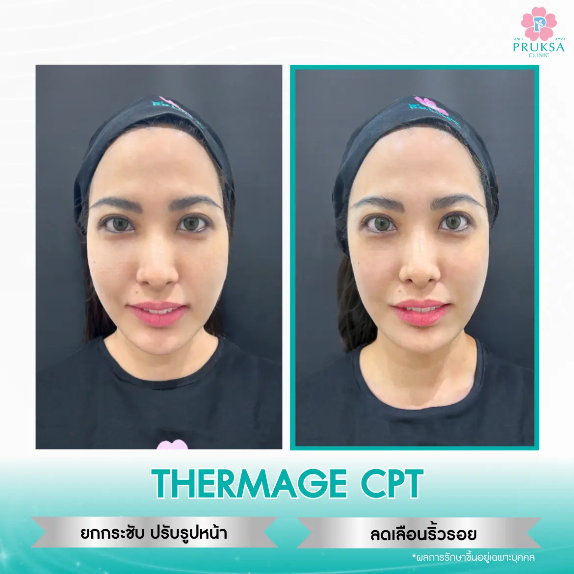 thermage-Before-After