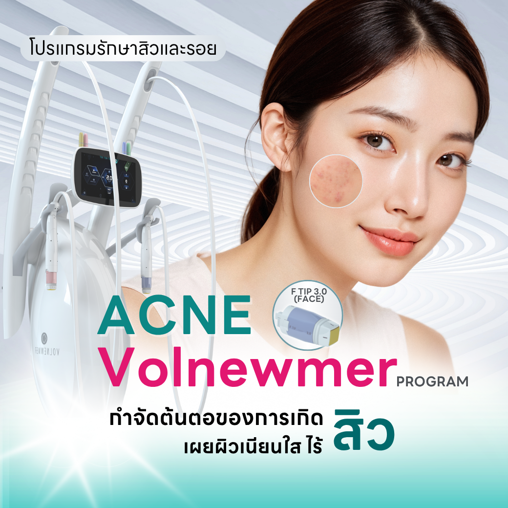 Acne Volnewmer Program