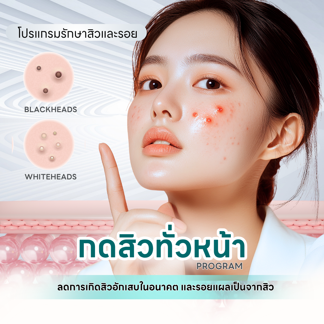 กดสิวทั่วหน้า โปรแกรม