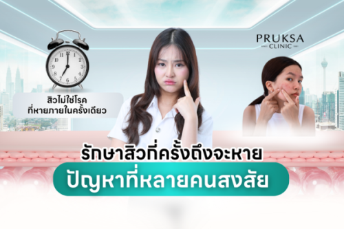 รักษาสิวกี่ครั้งถึงจะหาย? ปัญหาที่หลายคนสงสัย