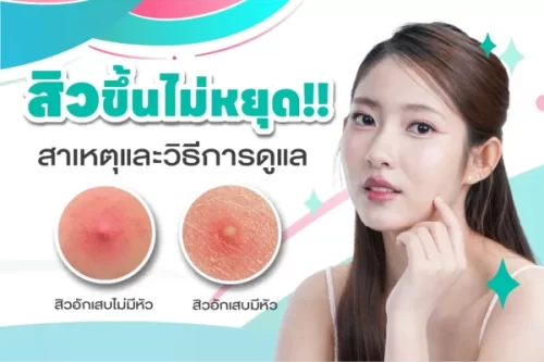 สิวเกิดจากอะไร?  รู้จักสาเหตุ วิธีรักษาให้ได้ผล