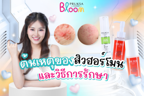 ต้นเหตุของสิวฮอร์โมน และวิธีการรักษา