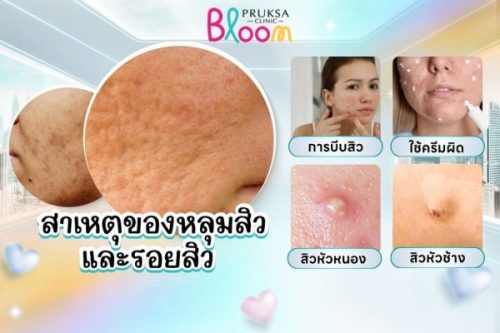 สาเหตุของการเกิดหลุมสิวและรอยสิว