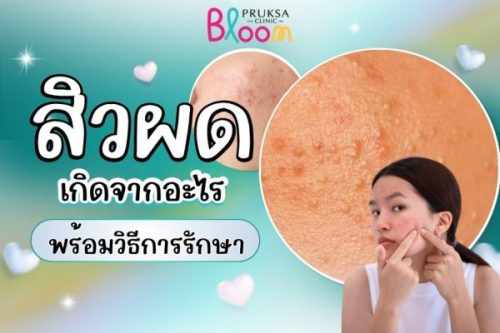 สิวผดเกิดจากอะไร? รวมสาเหตุ สิ่งกระตุ้น และวิธีดูแลให้ผิวกลับมาใส