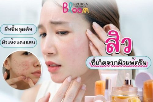 ผิวที่แพ้ครีมจนทำให้เกิดสิว