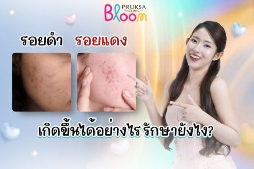 วิธีกำจัดรอยดำจากสิว