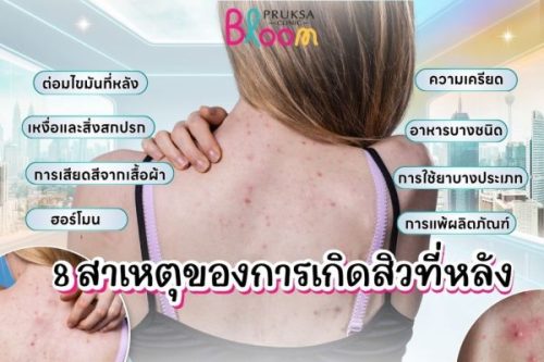 8 สาเหตุของการเกิดสิวที่หลัง รู้ทันต้นเหตุ เพื่อผิวเนียนใสไร้สิว